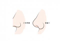 鼻翼不对称怎么矫正   鼻翼不对称如何矫正