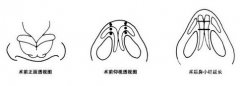 什么是鼻小柱延长 鼻小柱可以延长吗 什么是鼻小柱延长 鼻小柱可以延长吗