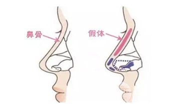 假体隆鼻手术过程  假体隆鼻后注意事项