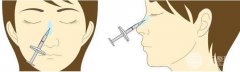 注射隆鼻好还是假体好 假体隆鼻的果 注射隆鼻好还是假体好 假体隆鼻的果