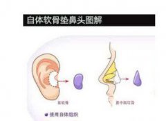 鼻中隔隆鼻和耳软骨哪个好 鼻中隔隆鼻和耳软骨哪个好