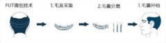 FUT植发什么原理?做FUT种植头发会留疤吗? FUT植发什么原理?做FUT种植头发会留疤吗?