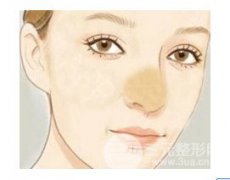 隆鼻失败多久能做修复  隆鼻三次仍然失败可以多久后修复
