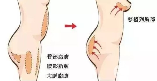 做自体脂肪移植隆胸降低风险吗 自体脂肪移植隆胸优缺点