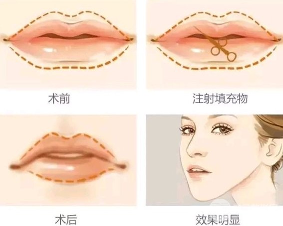 玻尿酸可以丰唇吗 玻尿酸丰唇好不好