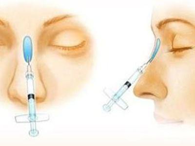 注射隆鼻材料有哪些  注射隆鼻的费用