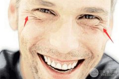 男士去鱼尾纹有什么方法