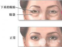 吸脂术去眼袋优缺点有哪些