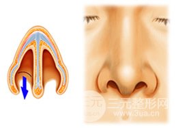 朝天鼻整形恢复期多久