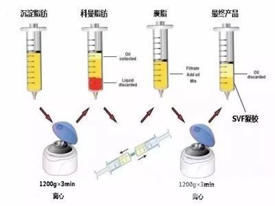 自体脂肪填下巴优缺点分析