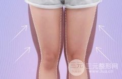 腿部抽脂后多久能够走路?术后怎么保养