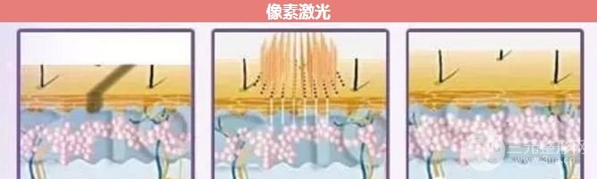 像素激光会留疤吗?怎样避免疤痕产生