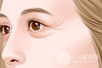 玻尿酸去除鱼尾纹果怎么样