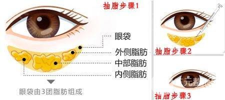 吸脂术去眼袋有无什么副作用