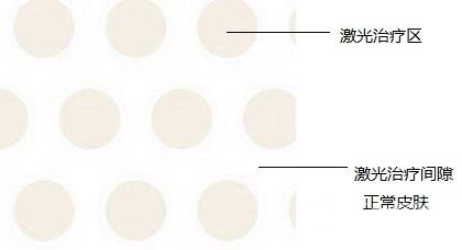 像素激光缓解原理