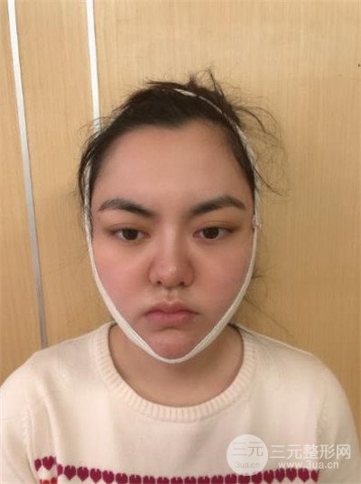 下颚缘双下巴吸脂案例分享,附恢复过程图片