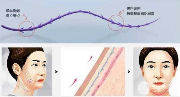 鋸齿线面b提升术多久见?果又能维持多久喃? 鋸齿线面b提升术多久见?果又能维持多久喃?