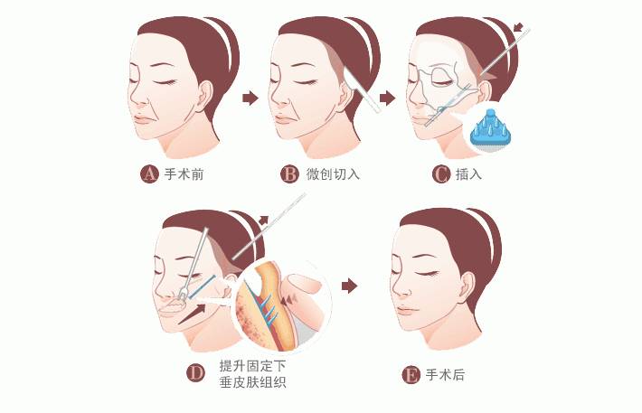 鋸齿线面b提升术