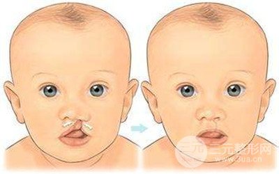 孩子兔唇可以治好吗？孩子兔唇几岁缓解比较好？