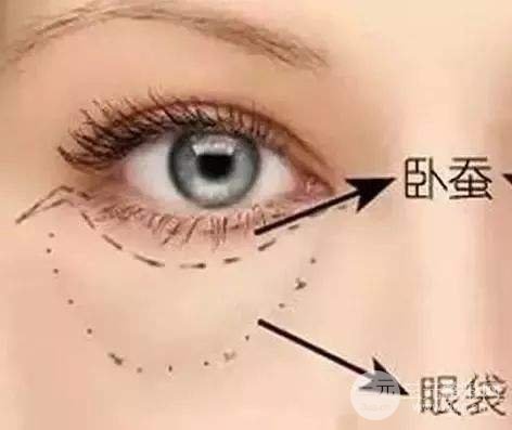 去眼袋