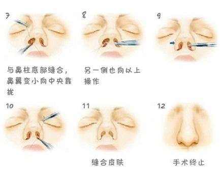 鼻孔缩小手术