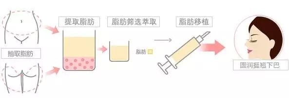 自体脂肪短下巴整形