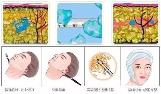 面部光纤溶脂