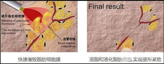 面部光纤溶脂