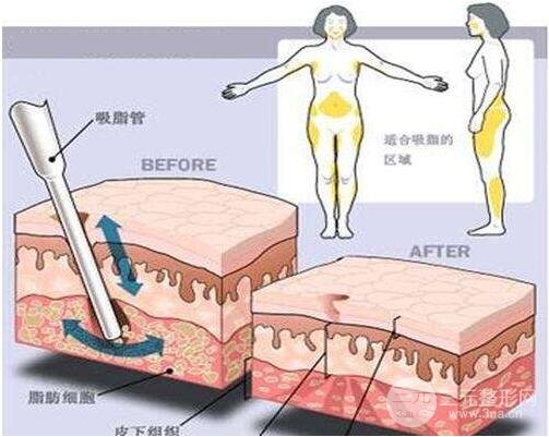 抽脂