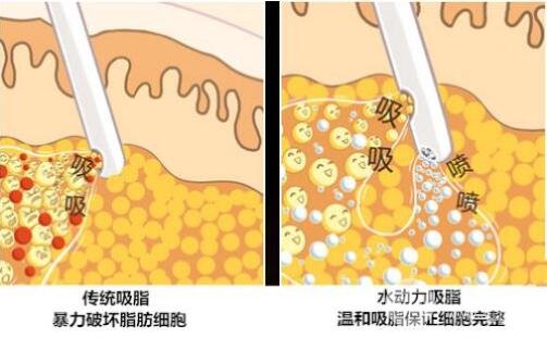抽脂