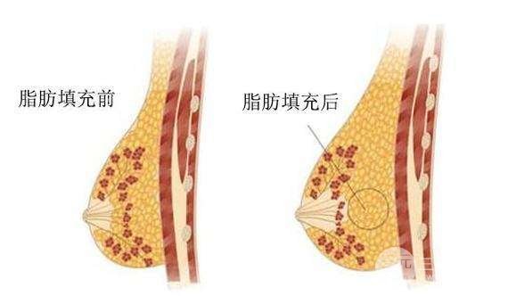 自体细胞丰胸