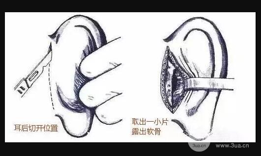 软骨隆鼻术