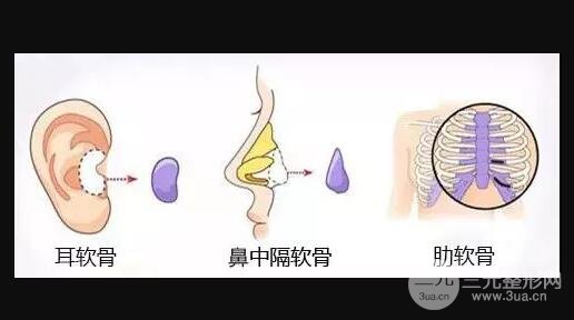 软骨隆鼻术