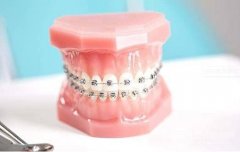 成人矫正牙齿大概要多少钱？