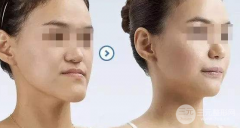 牙槽骨突出矫正手术果怎么样？