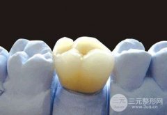 三甲医院做镍铬烤瓷牙多少钱?