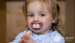 儿童龅牙矫正价钱是多少？怎么收费的？