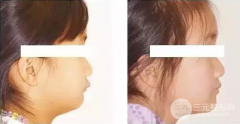 儿童龅牙怎么自己矫正?有什么帮助矫正的方法吗?