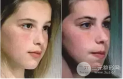 龅牙矫正对比明X吗?真实换牙如换脸