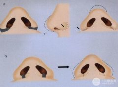 宽鼻矫正术后多久才能恢复？如何护理有助于更好恢复喃？