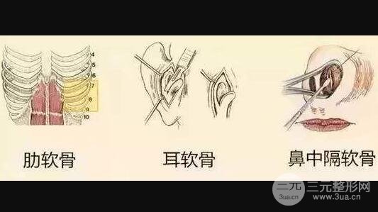 耳软骨垫鼻梁