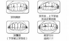 牙齿突出来好难看,牙齿突出是有什么问题? 牙齿突出来好难看,牙齿突出是有什么问题?