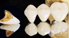 镍铬烤瓷牙的危害很大吗？镍铬烤瓷牙会致癌是真的吗？