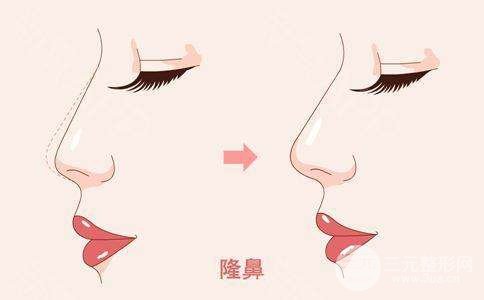自体脂肪隆鼻