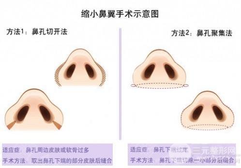 鼻孔缩小