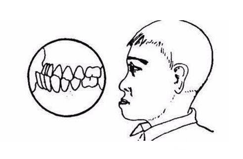 上颌后缩矫正