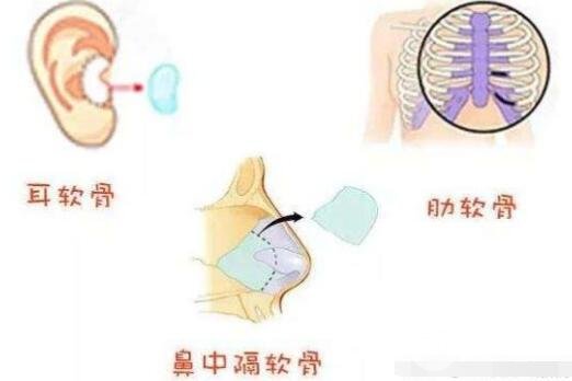 鼻中隔软骨隆鼻