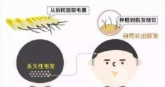 发际线调整能维持几年?还是不会再反弹呢？