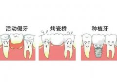 镶牙一般都要经过哪几个阶段呢|镶牙过程详细分享~