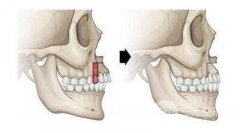 上牙槽骨突出要用什么方法矫正好？很想了解一下！